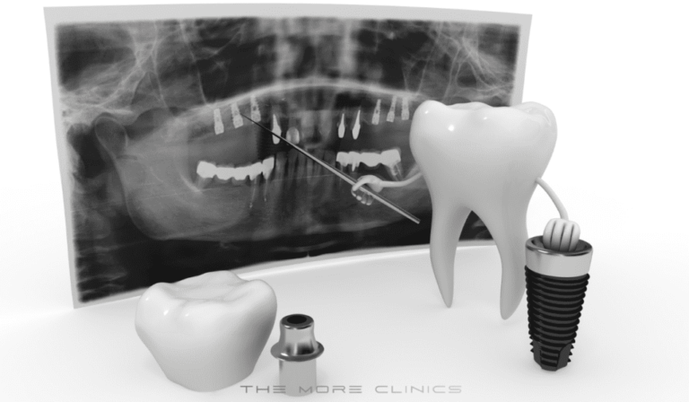 Antalya Dental Implants