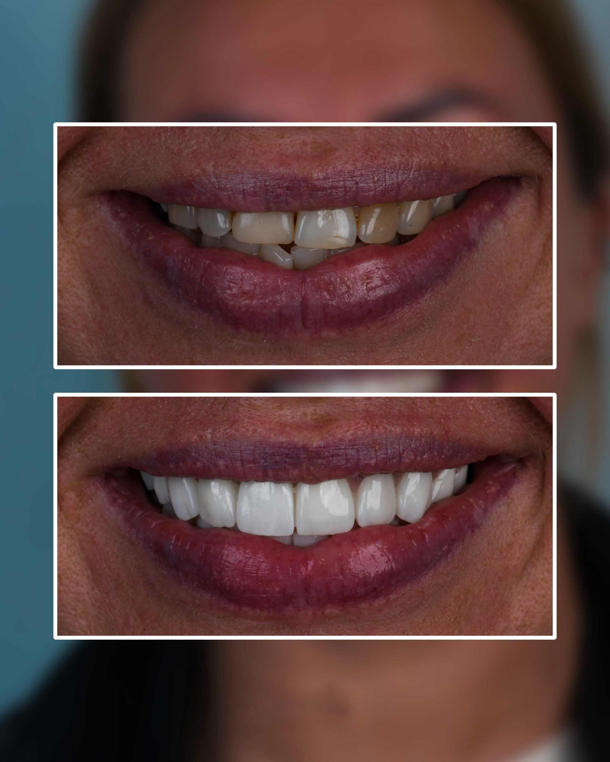 smile makeover before and after result of a patient