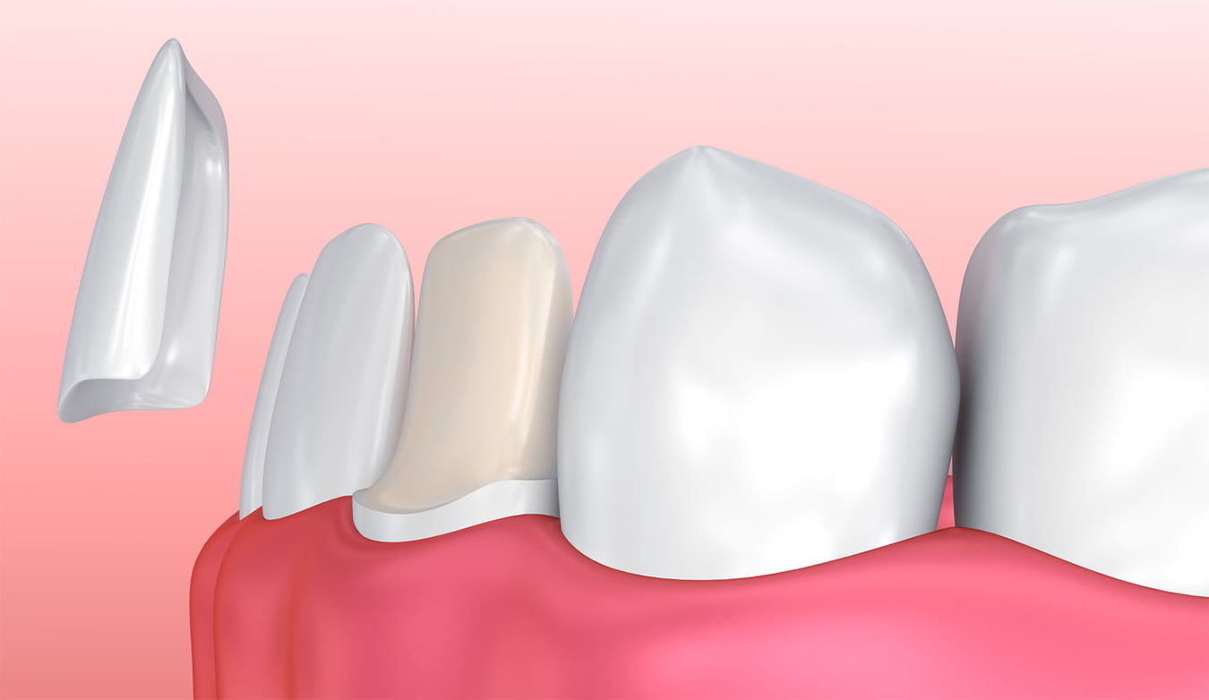 Carillas Dentales Antalya - Carillas Laminadas Turquía