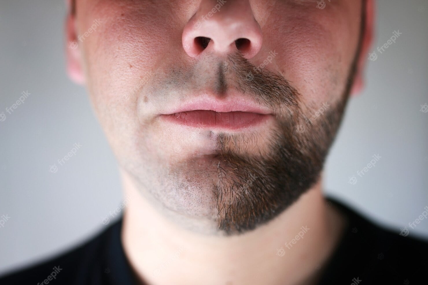 beard transplant candidate patient