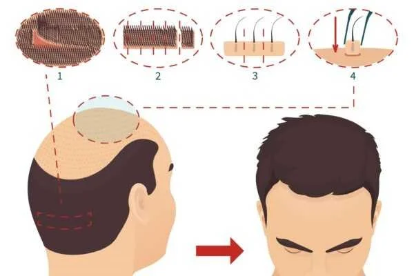 Antalya FUE Hair Transplant Turkey
