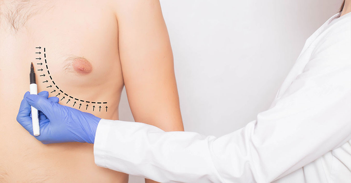 Mamoplastia Masculina Antalya - Ginecomastia Turquía