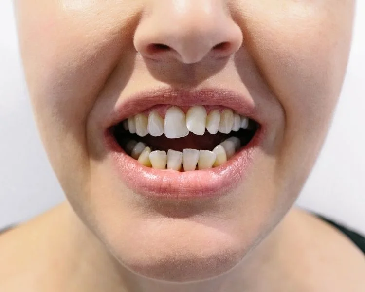 crooked teeth treatments