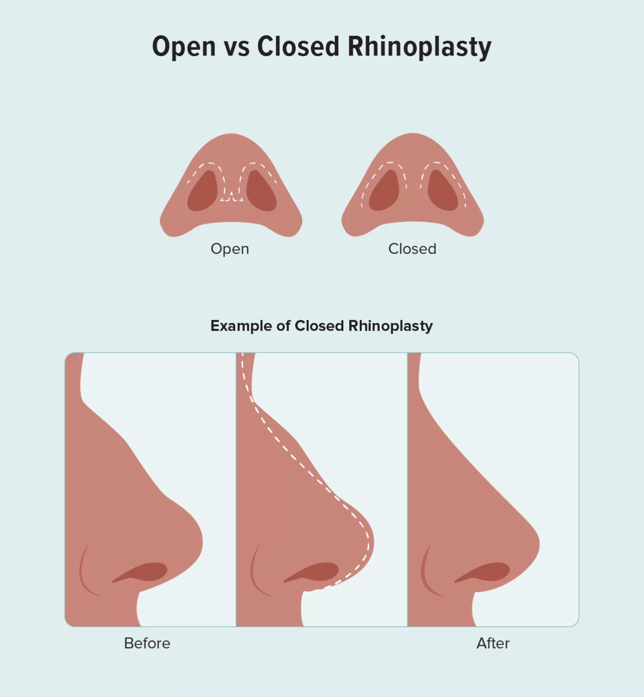 rhinoplasty in turkey
