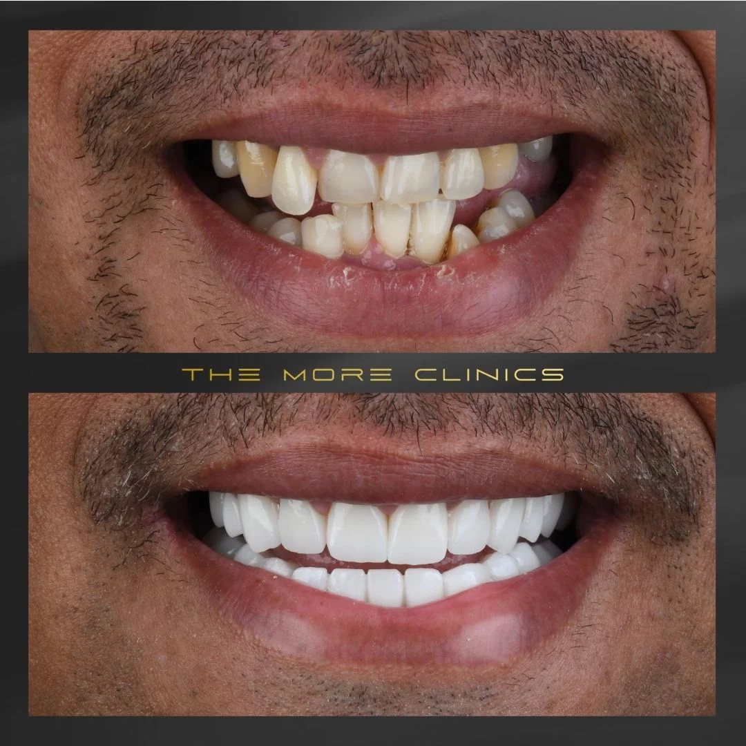 veneers for crooked teeht before and after