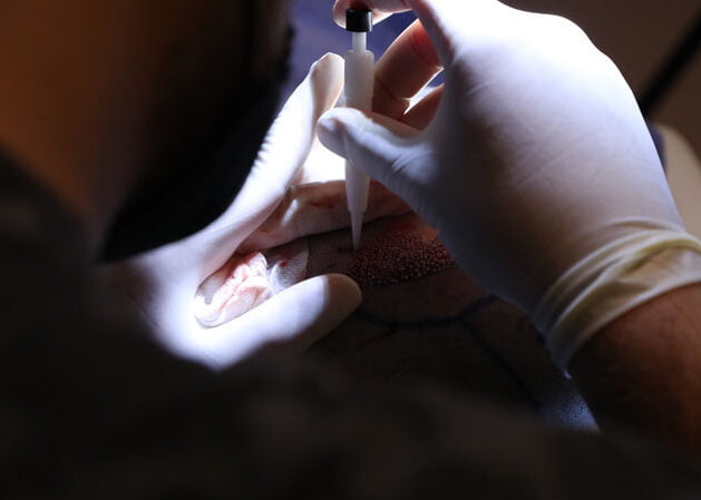 dhi hair transplantation with choi pen