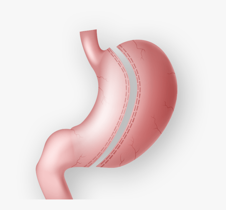 Antalya Gastric Sleeve Surgery Turkey