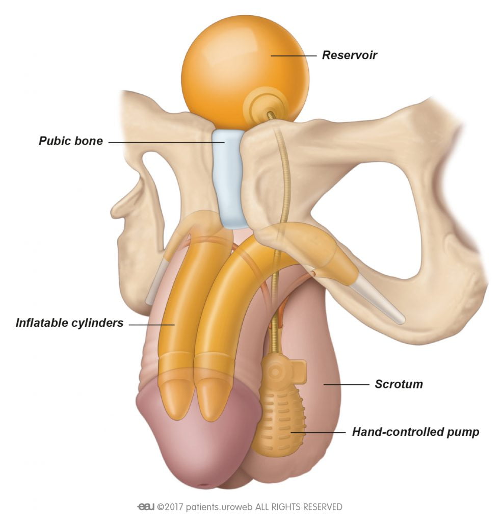 penile prosthetis penile implants turkey
