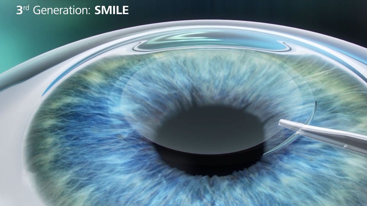 3rd generation of eye surgery