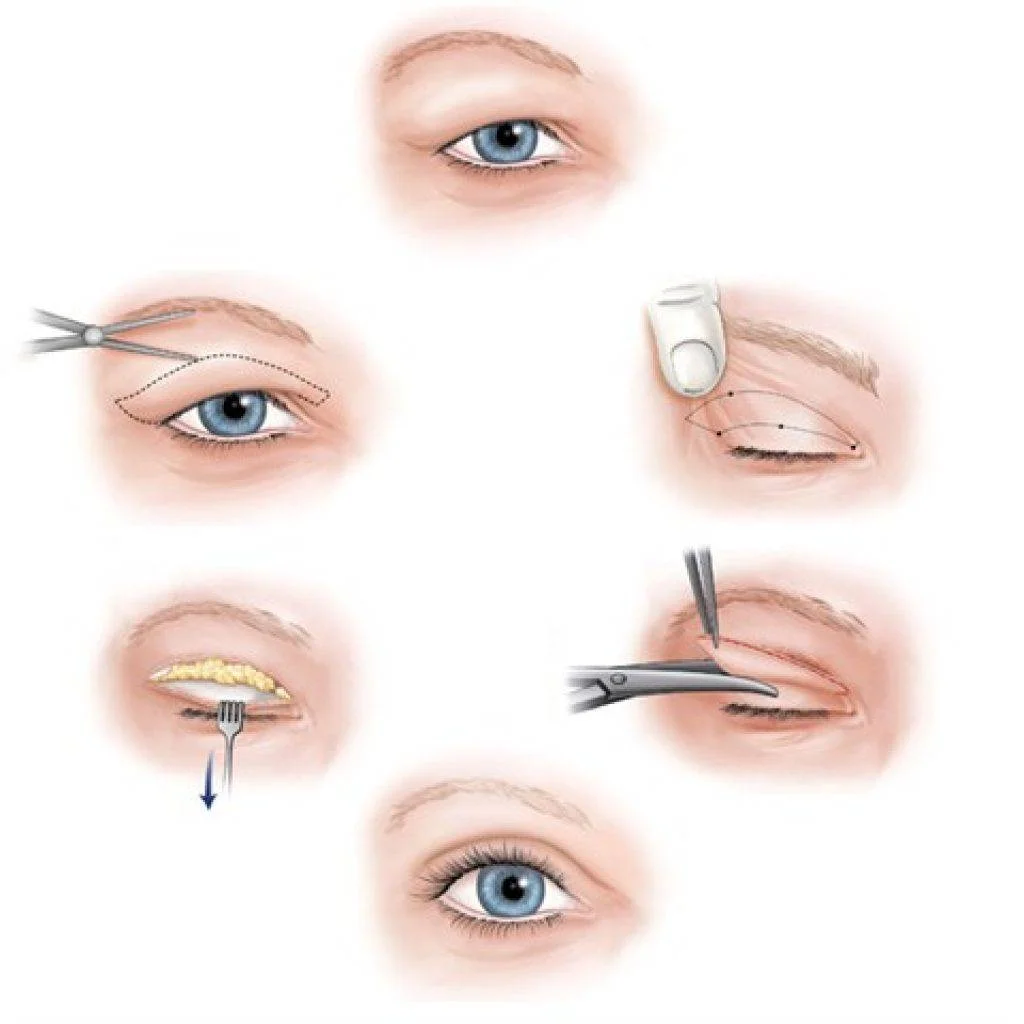 eyelid surgery blepharoplasty turkey