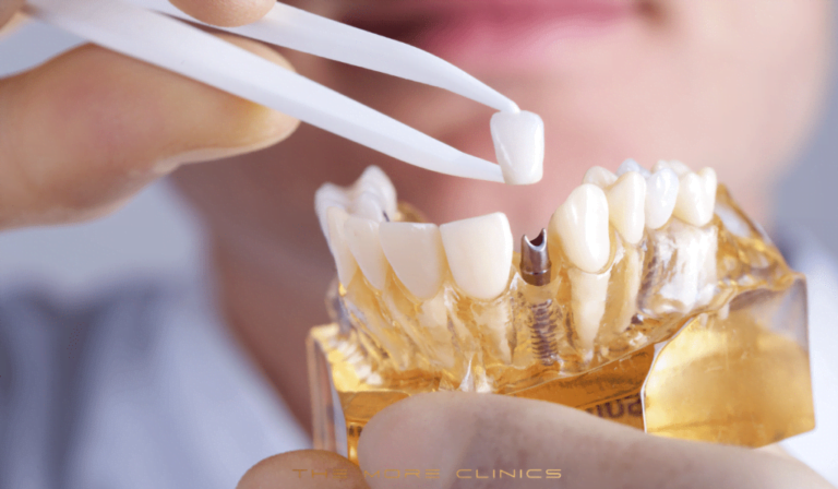 Antalya Dental Implants Turkey