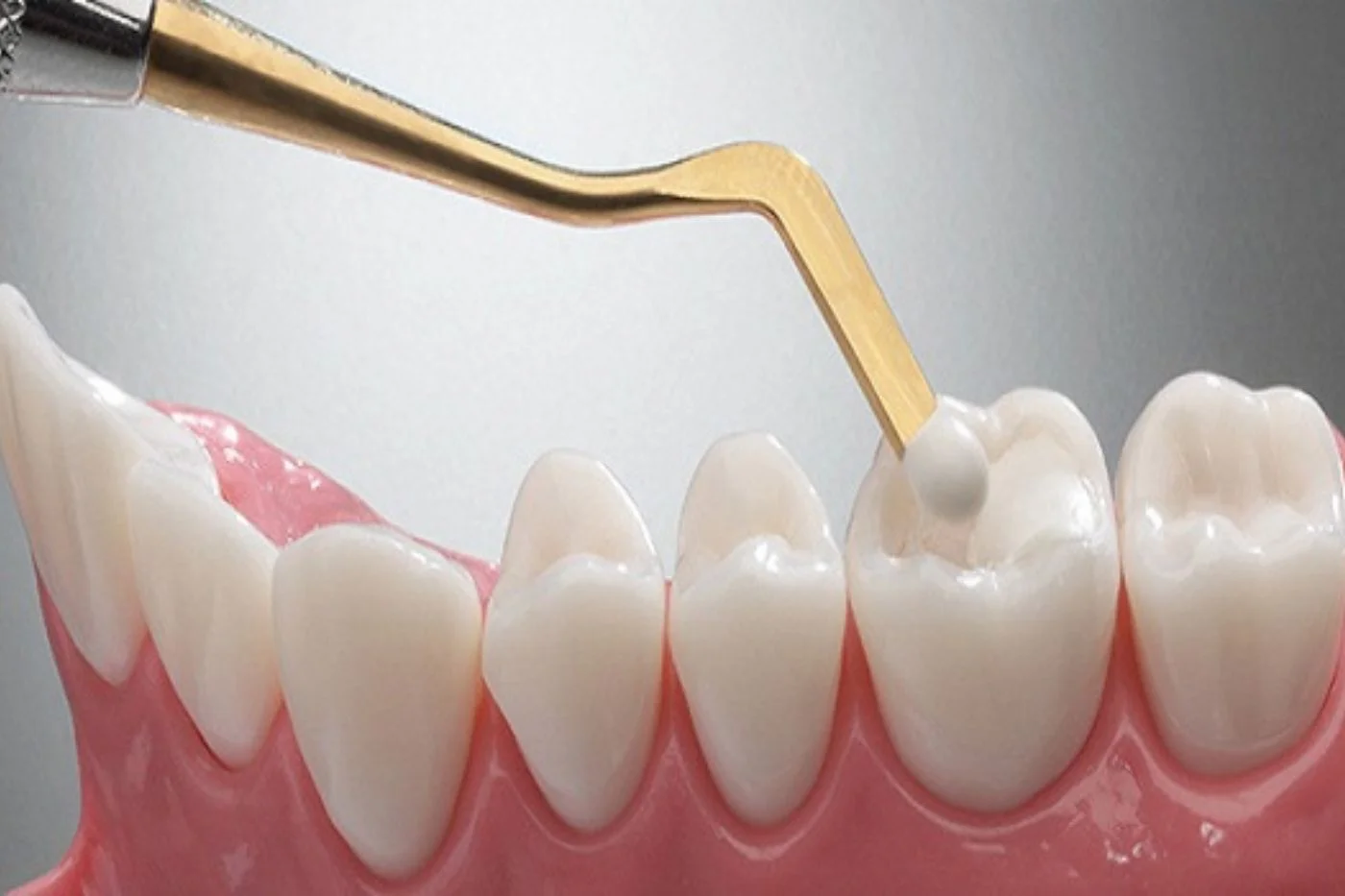 composite resin filling