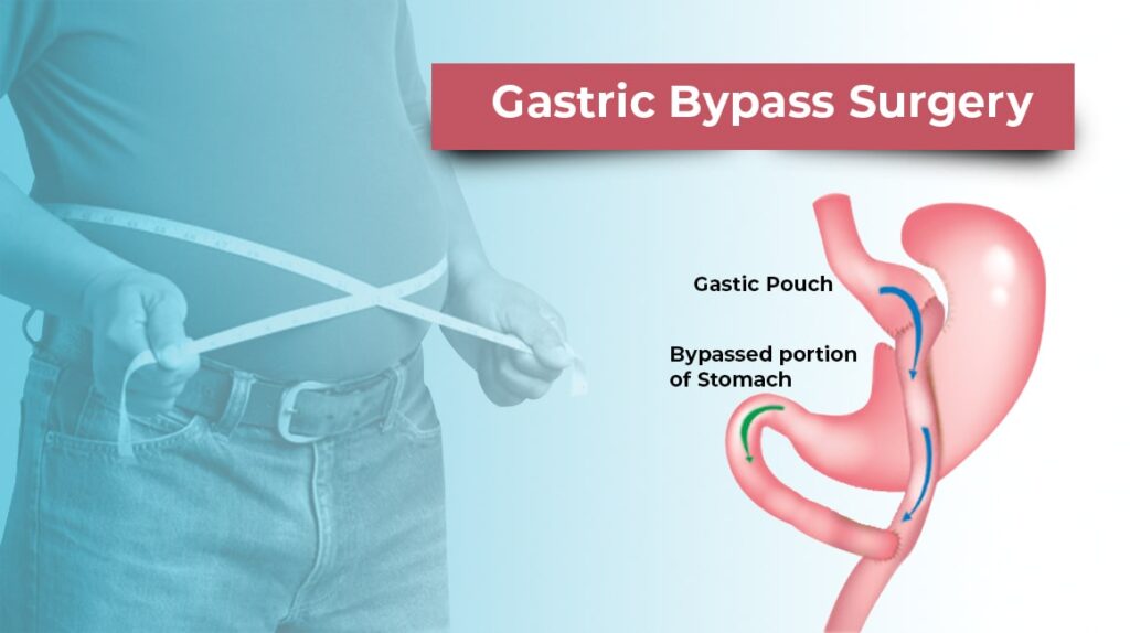 gastric bypass surgery turkey