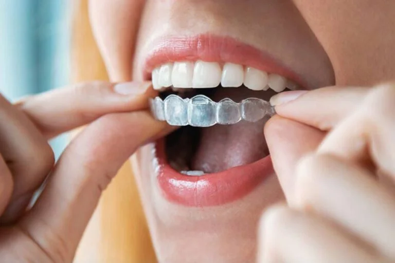 Invisalign Kosten – ​(durchsichtige unsichtbare zahnspange kosten türkei ekle