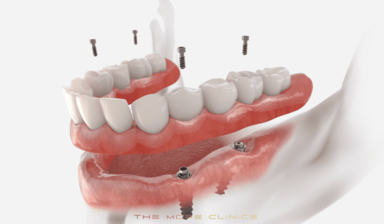 All on 4® Dental Implants: A Comprehensive Guide
