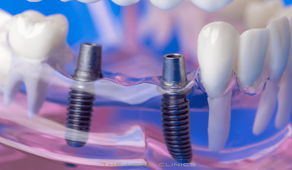 Snap On Dentures Vs All On 4 Implant Dentures Comparison The More Clinics