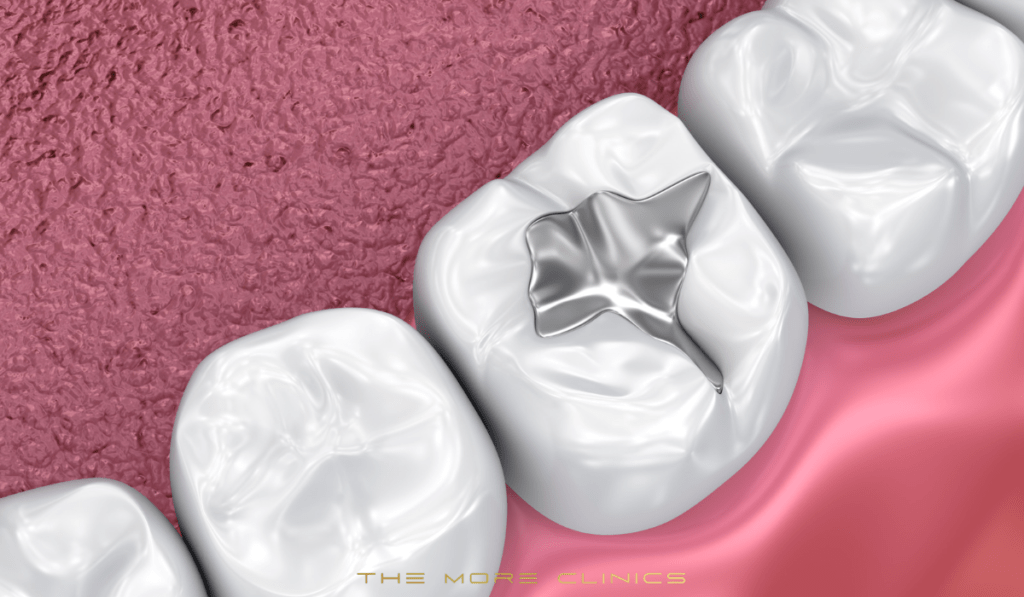 dental fillings