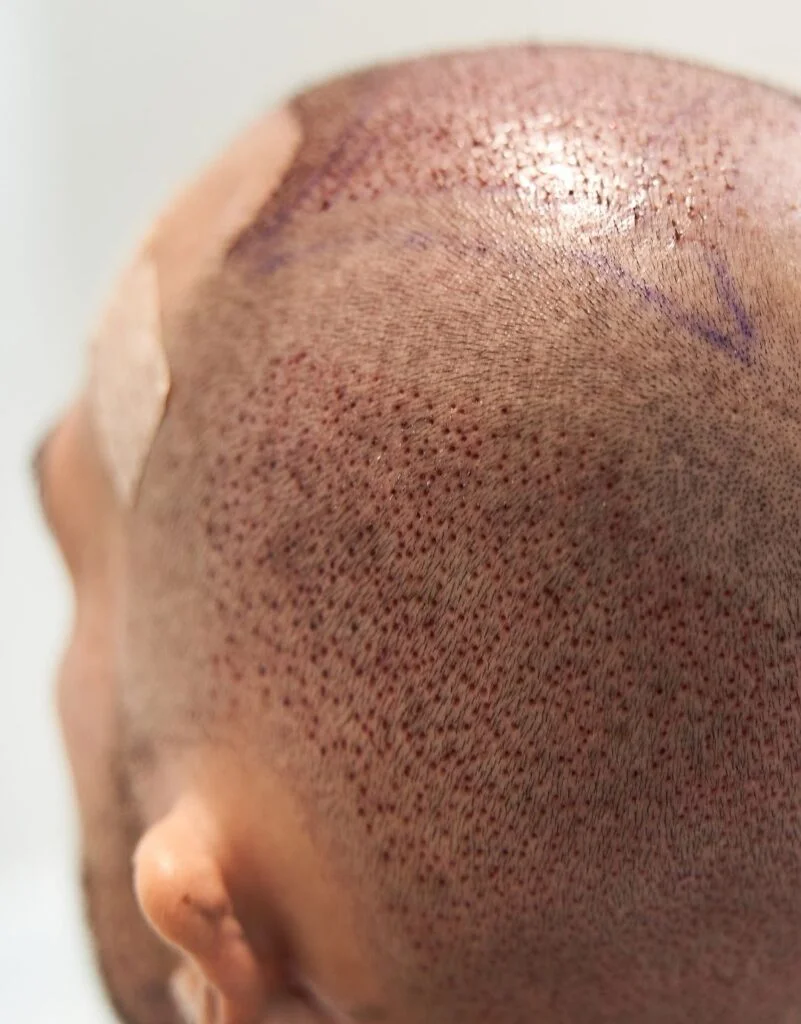 best candidates for hair transplant turkey antalya