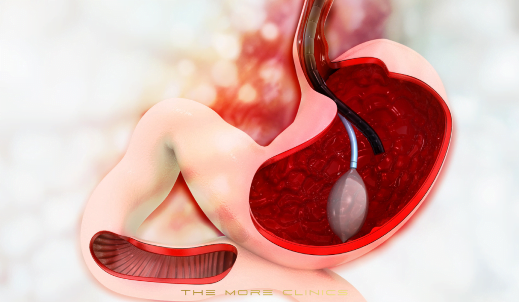 gastric ballon, obesity surgery in turkey