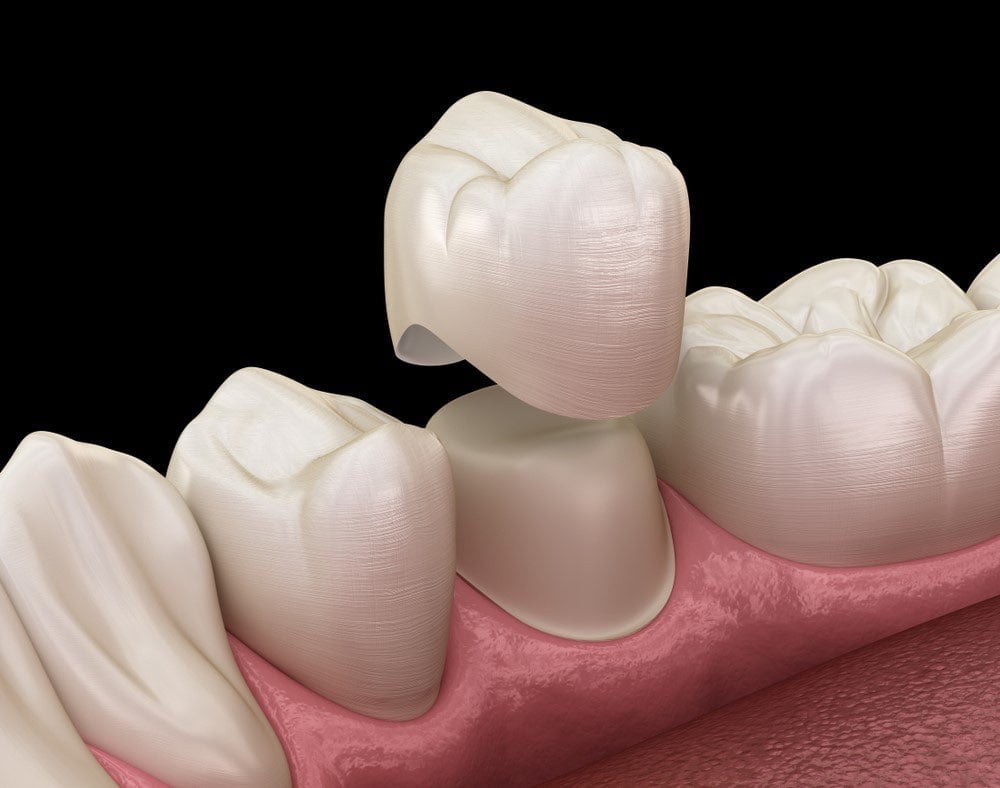 dental crown placement