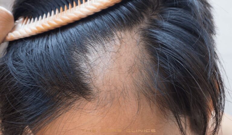 Antalya Hair Transplant