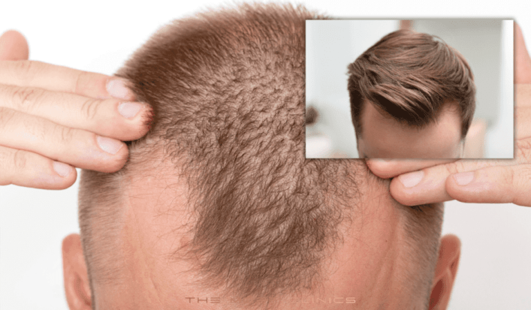 A Comprehensive Guide to FUE Hair Transplant Turkey