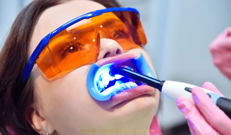Zahnaufhellung – Zähne Bleaching Kosten