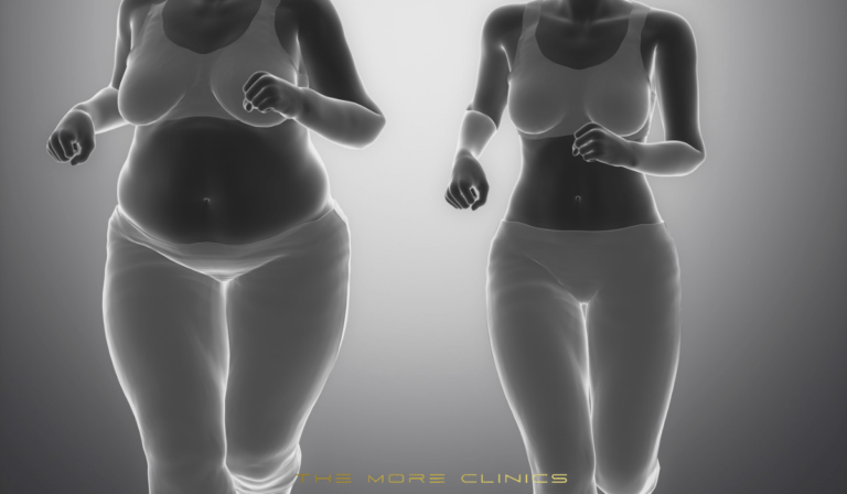 Antalya Weight Loss Turkey