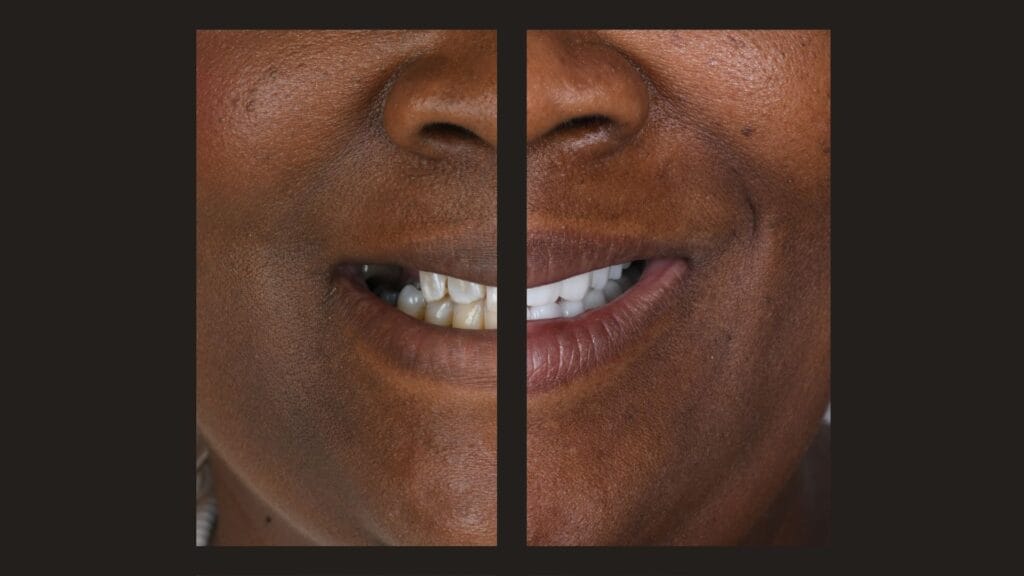 399$ dental implants turkey option