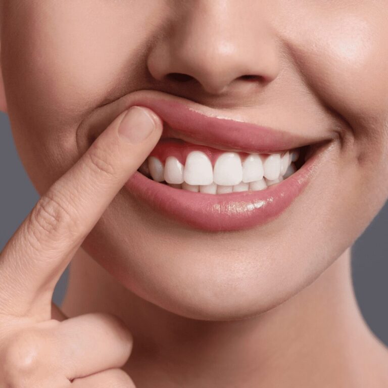 Antalya Bleeding Gums