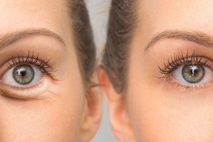 Blepharoplasty in Turkey, Antalya