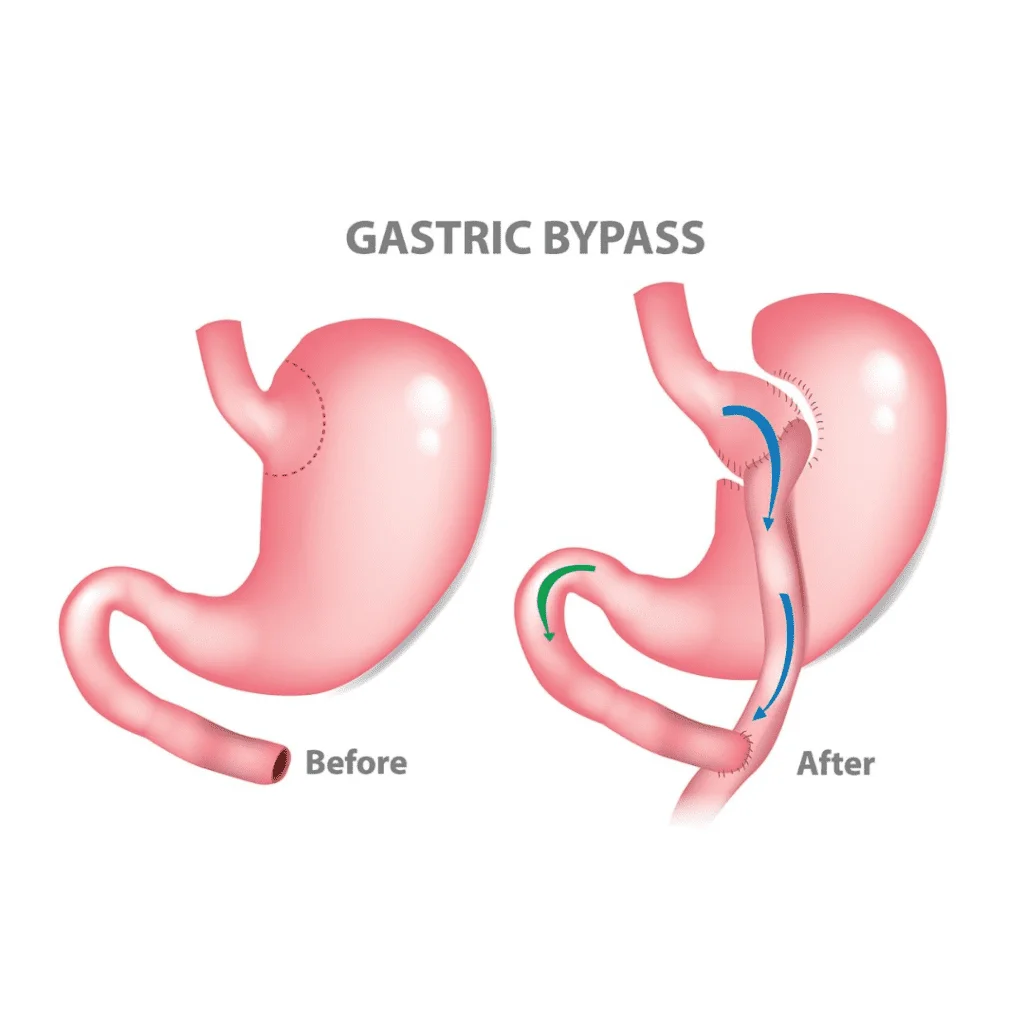 gastric bypass before and after