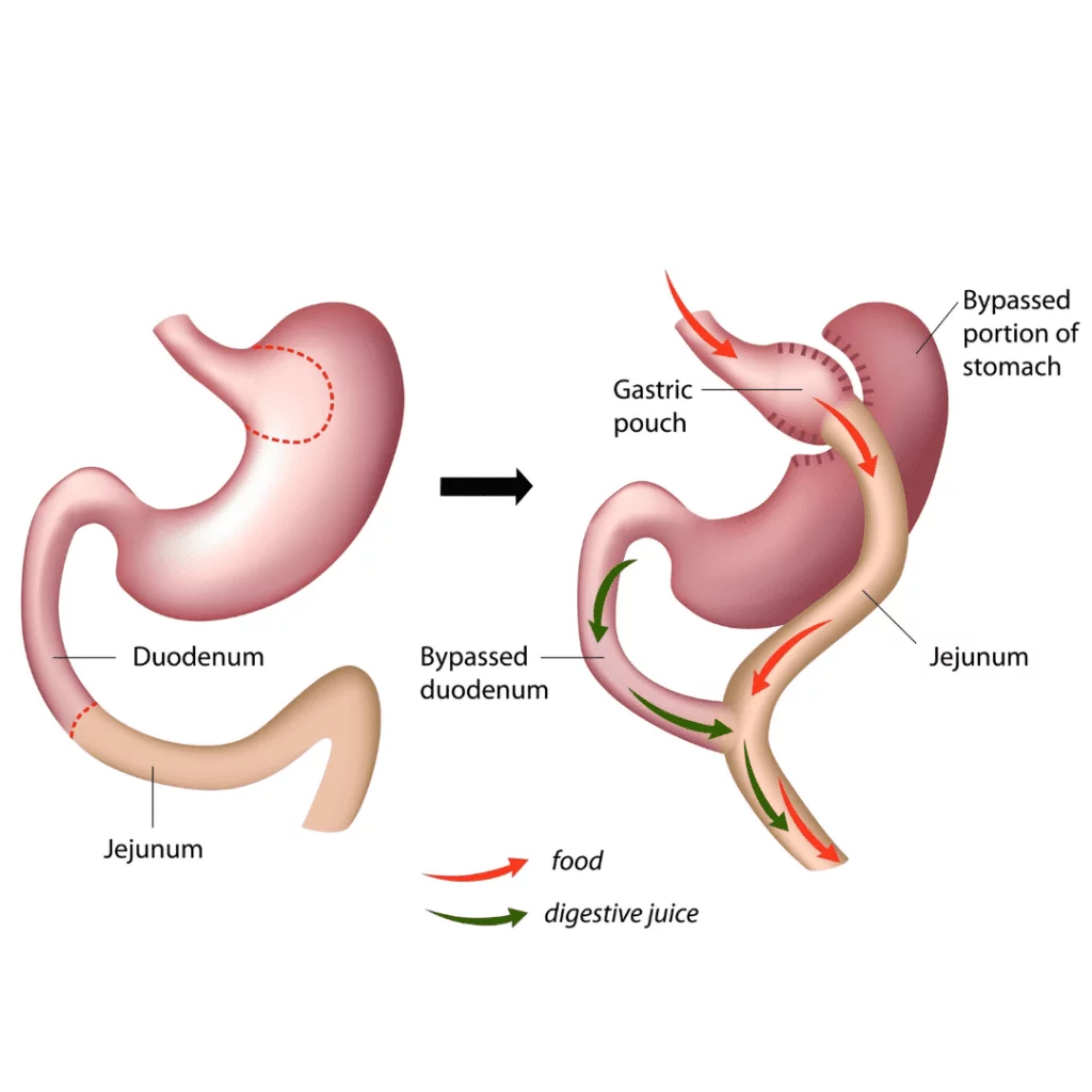 What is Gastric Bypass Surgery