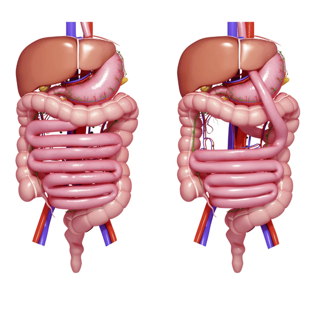 gastric bypass surgery