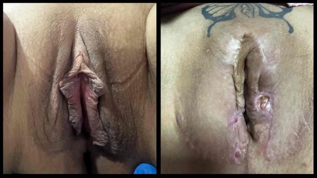 botched labiaplasty before and after