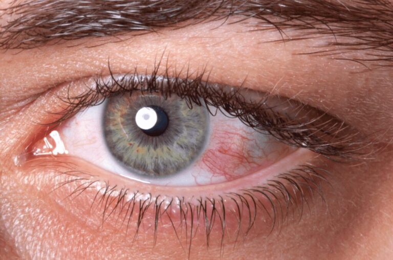 Pink Eye (Conjunctivitis): Symptoms and Treatment
