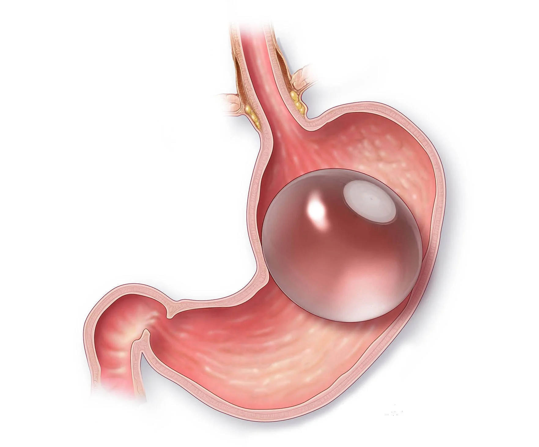 day of gastric balloon antalya turkey