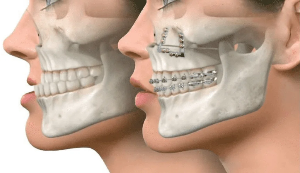 What is Ortognatic Surgery Turkey?