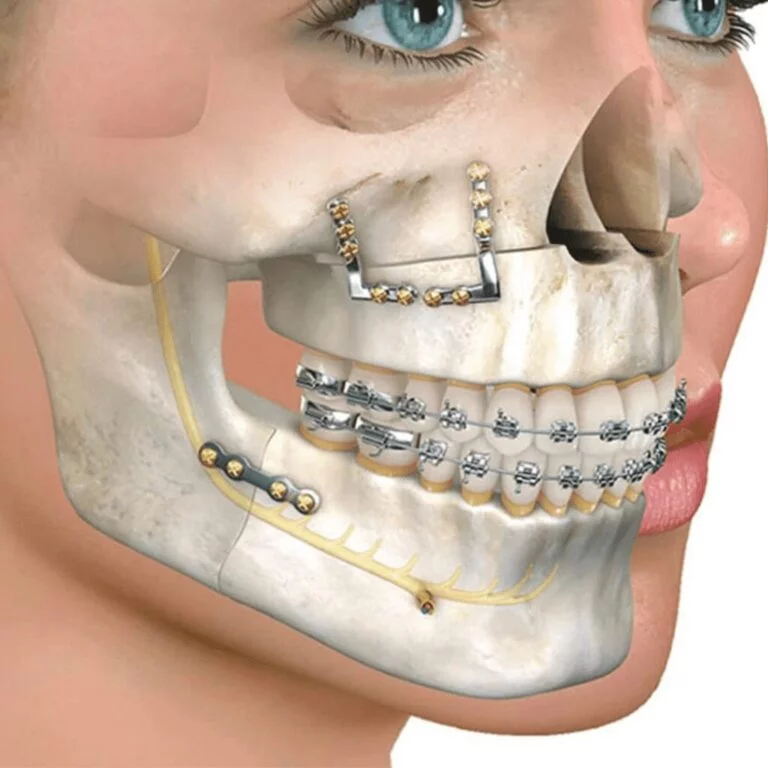 Ortognatic Surgery Turkey