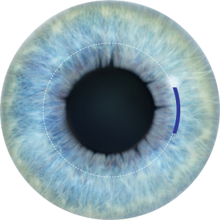 antalya relex smile eye laser recovery tips
