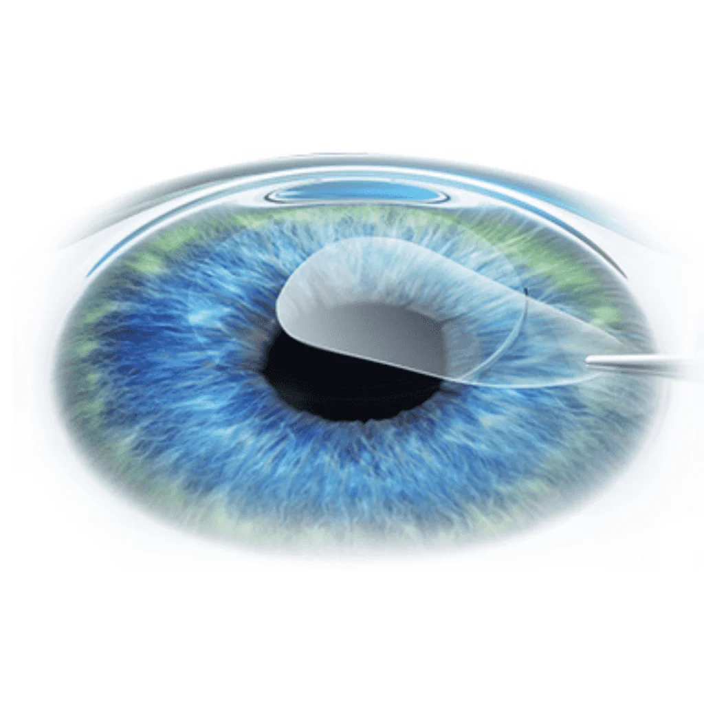relex smile eye laser recovery