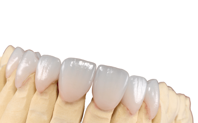 composite veneers antalya turkey as a type of dental veneer
