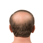 Male Pattern Baldness Turkey