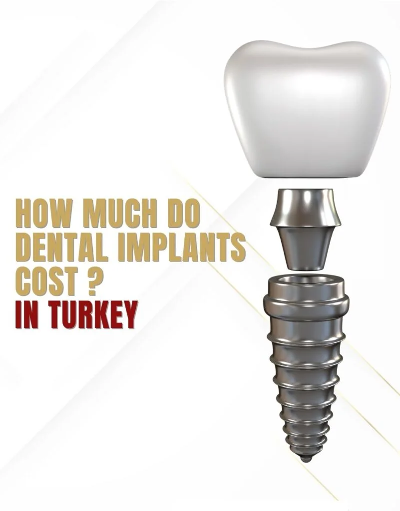 Antalya Dental Implants Price Turkey