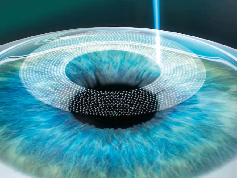 Antalya Ilasik Eye Laser Surgery