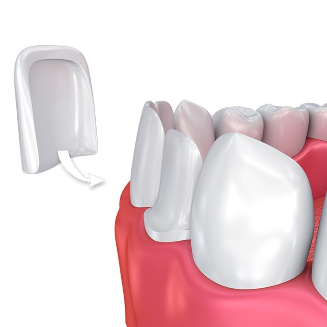 porcelain veneer as a type of dental veneers antalya