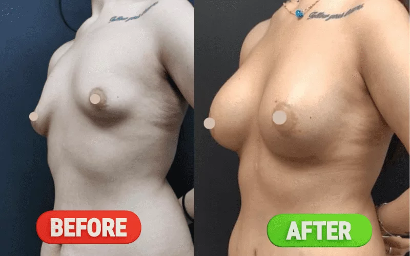 breast augmentation before and after results