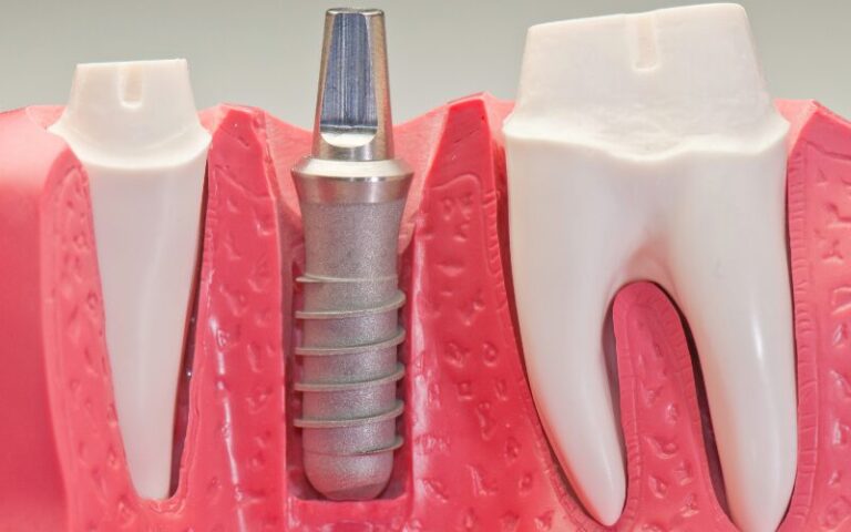Antalya Dental Implant