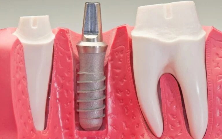 Day of Dental Implant Procedure