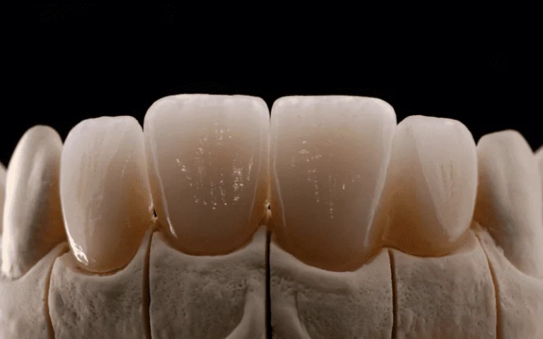 All Myths Explained About Dental Veneers